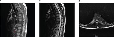 Case report: Surgical treatment of a primary giant epithelioid hemangioendothelioma of the spine with total en-bloc spondylectomy